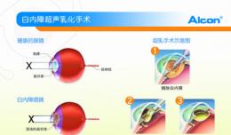 世界最先进超声乳化机落户我院
